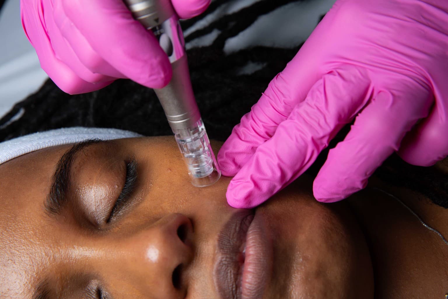 Skin assessment across tones before microneedling