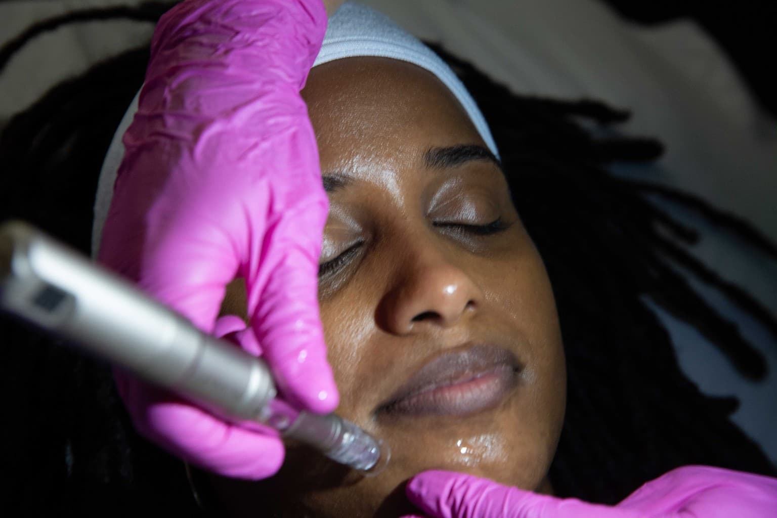 Clinical texture study related to acne scarring and the distinction from active acne