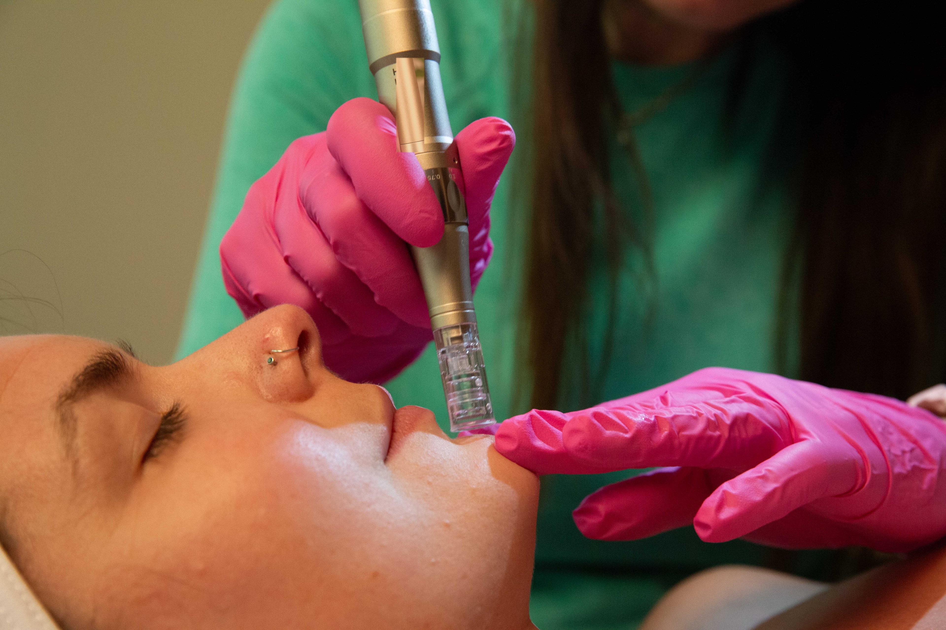 Precision device in use during microneedling care near Innsbrook